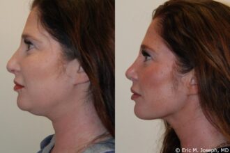 septoplasty in New Jersey